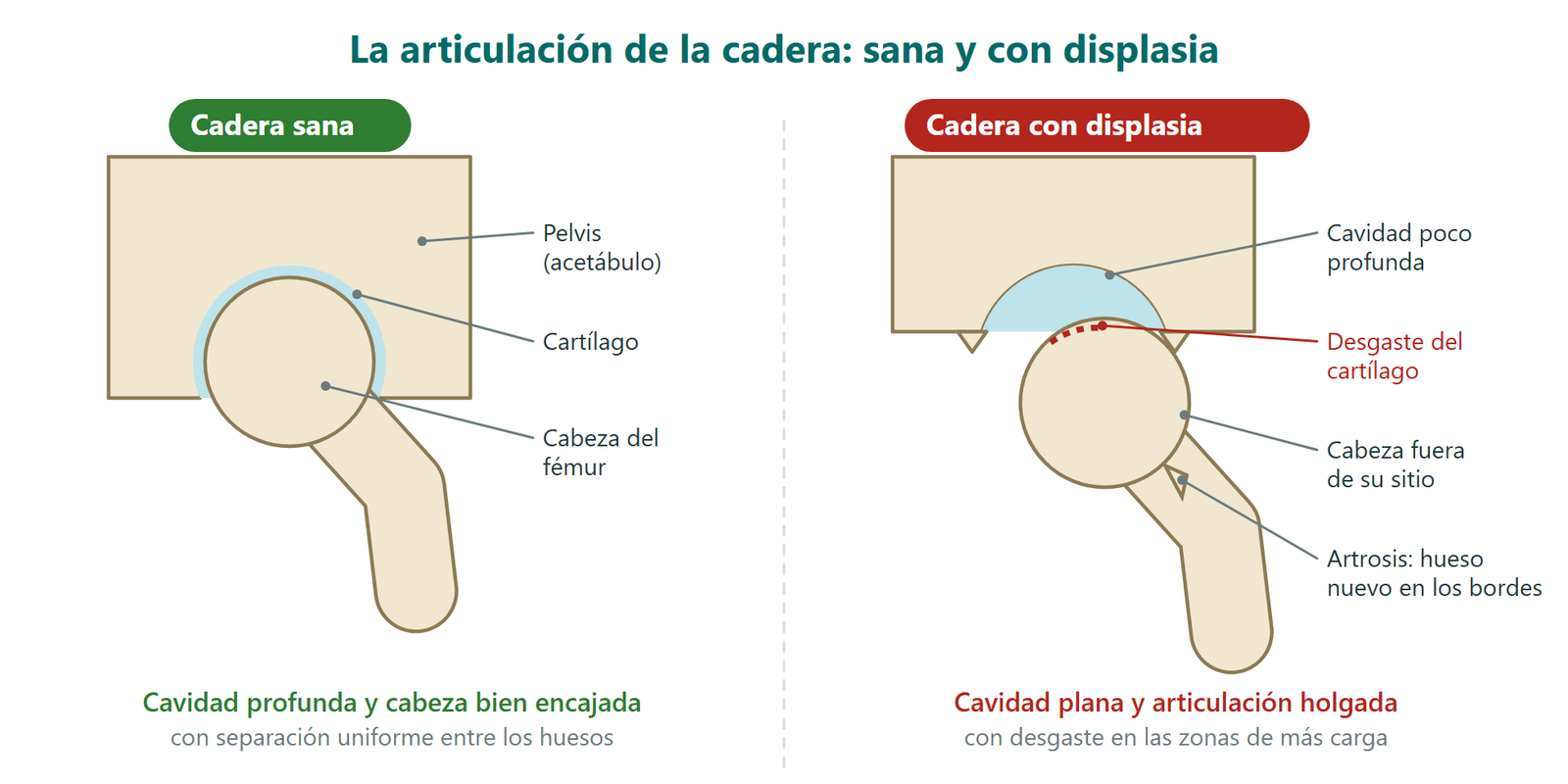 Esquema de una cadera sana frente a una cadera con displasia: cavidad profunda y cabeza bien encajada frente a cavidad plana, cabeza desplazada, desgaste del cartílago y artrosis