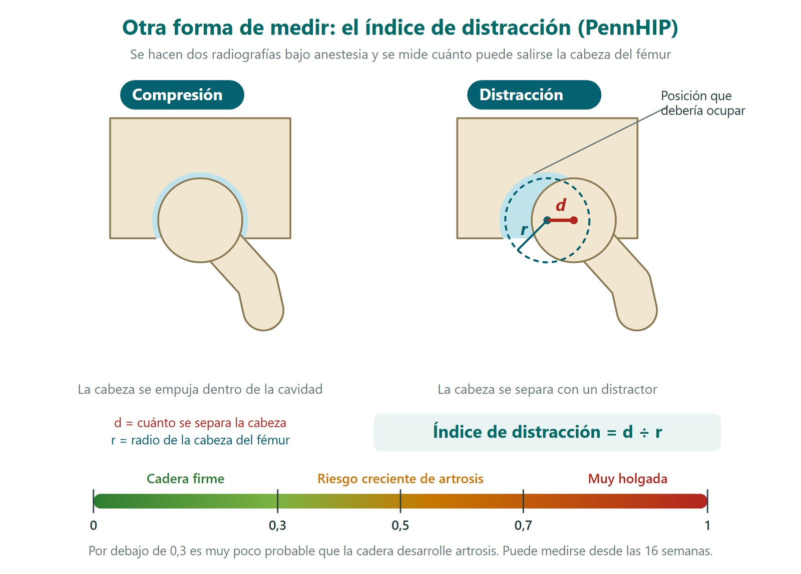 Esquema del método PennHIP: radiografía en compresión y en distracción, cálculo del índice de distracción como d entre r y escala de riesgo de 0 a 1